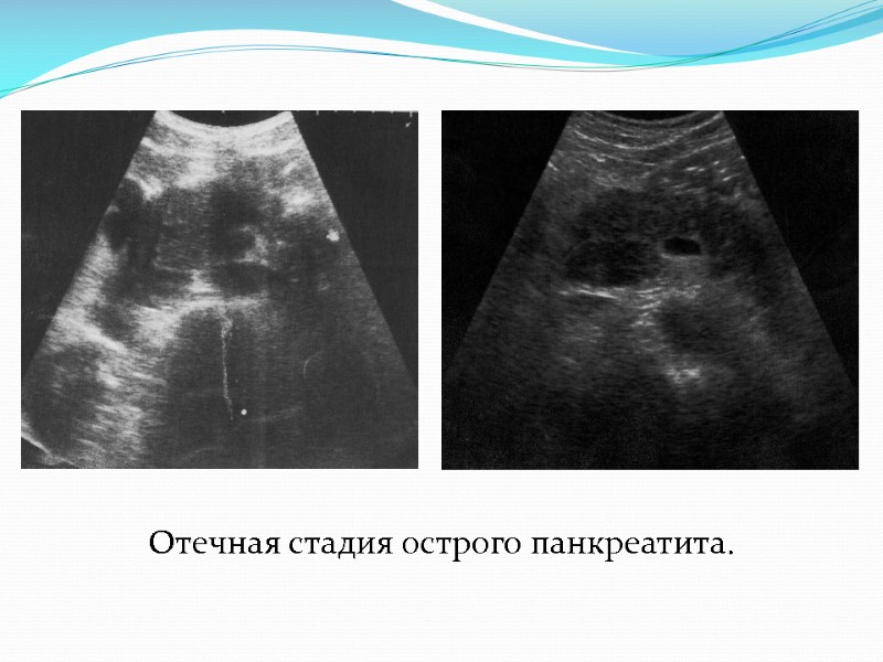 Отечная стадия острого панкреатита.